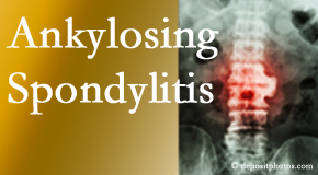 Ankylosing spondylitis is gently cared for by your Augusta chiropractor.