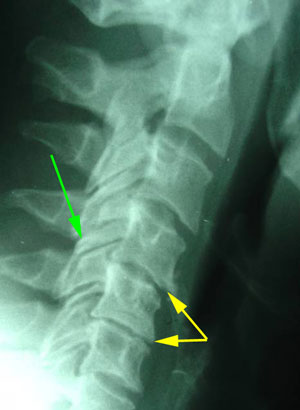 disc degeneration treated at Lombardy Chiropractic Clinic