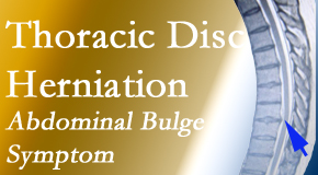 Lombardy Chiropractic Clinic cares for thoracic disc herniation that for some patients prompts abdominal pain.