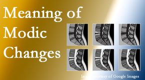 Lombardy Chiropractic Clinic sees many back pain and neck pain patients who bring their MRIs with them to the office. Modic changes are often noted. 