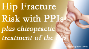 Lombardy Chiropractic Clinic shares new research describing higher risk of hip fracture with proton pump inhibitor use.
