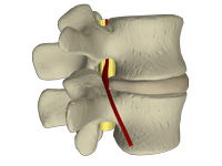 pain due to herniated disc before Cox Technic