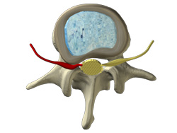 Herniated Lumbar Disc