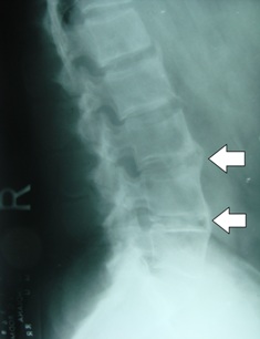 anklylosing spondylitis