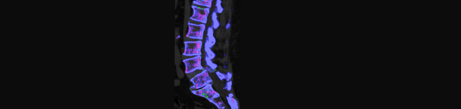 Lombardy Chiropractic Clinic is aware that inflammatory spinal gout is a differential diagnosis to consider for patients who present with back pain and other spine related symptoms.