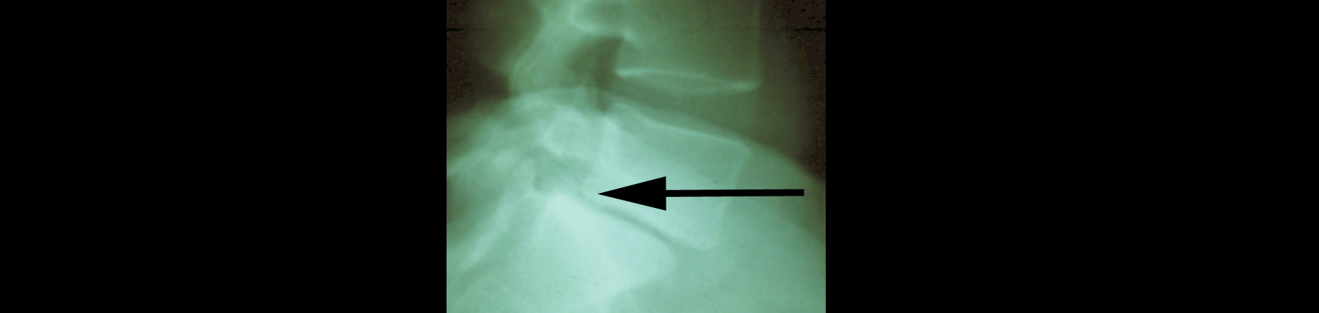 Augusta spondylolisthesis 