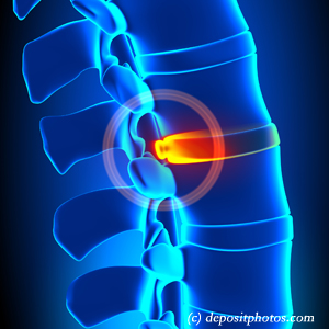 image of lumbar Augusta disc herniation