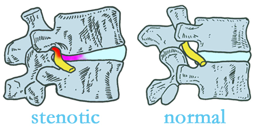 Augusta stenotic and normal spinal discs